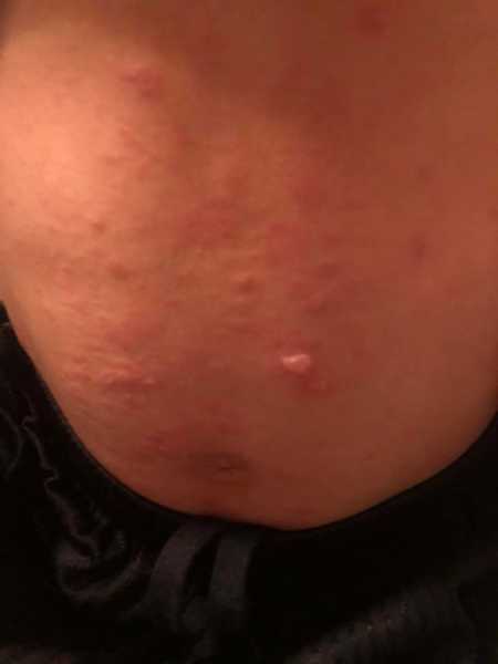 Stomach of little boy that has blisters on it from citrus burn
