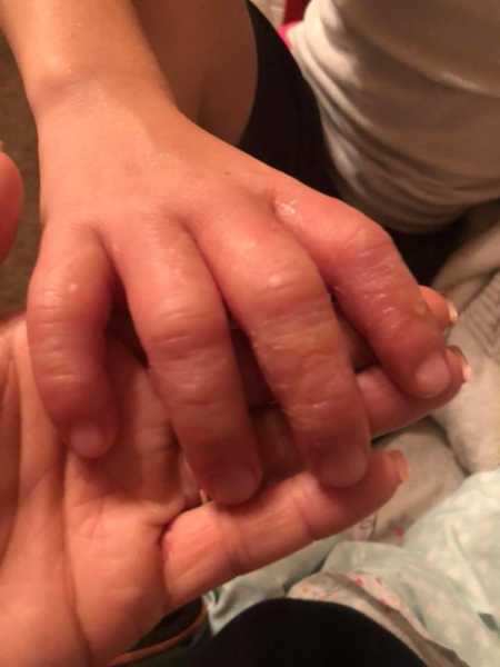 Swollen hand of little boy who has citrus burn