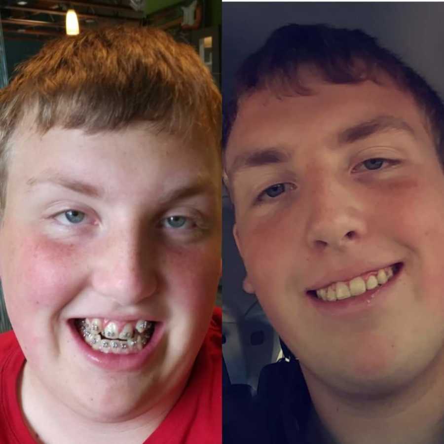 Teen during and after having braces whose father was taken by CPS as a kid