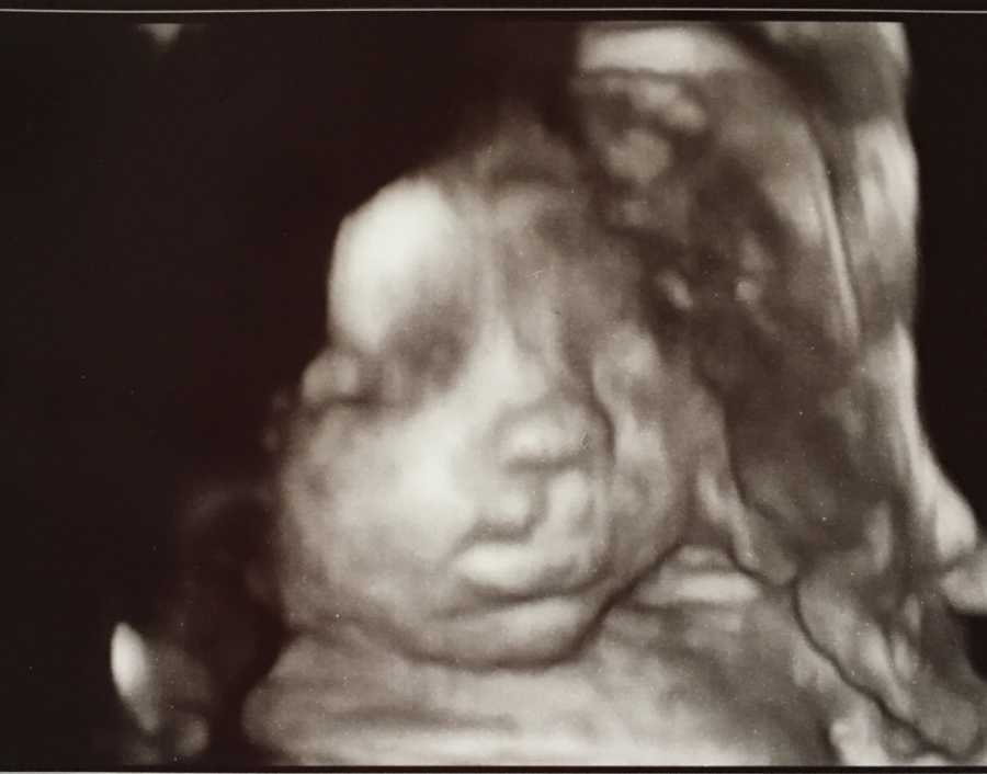 Ultrasound of baby who wasn't receiving nutrients from placenta