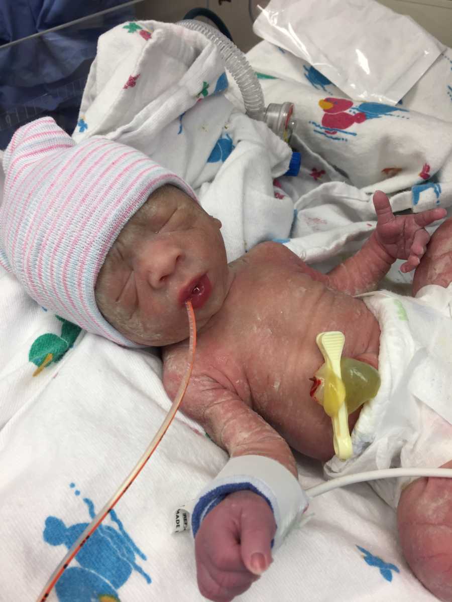 Newborn in NICU from being delivered too early 