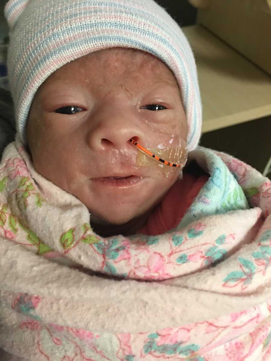 Newborn baby swaddled in blanket with tube up her nose