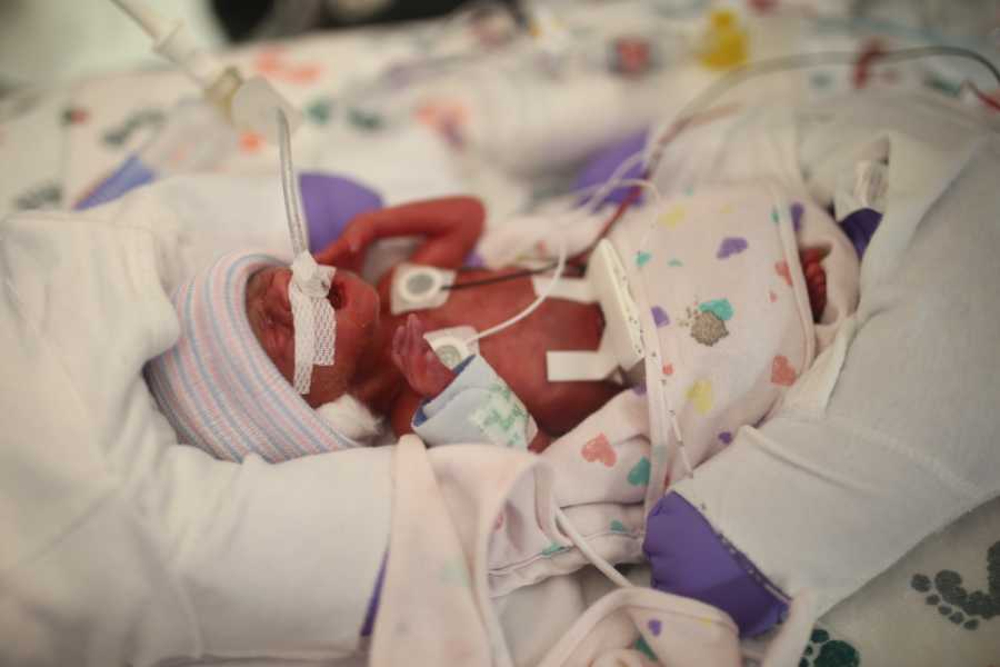 Close up of micro preemie in hospital with wires attached to her