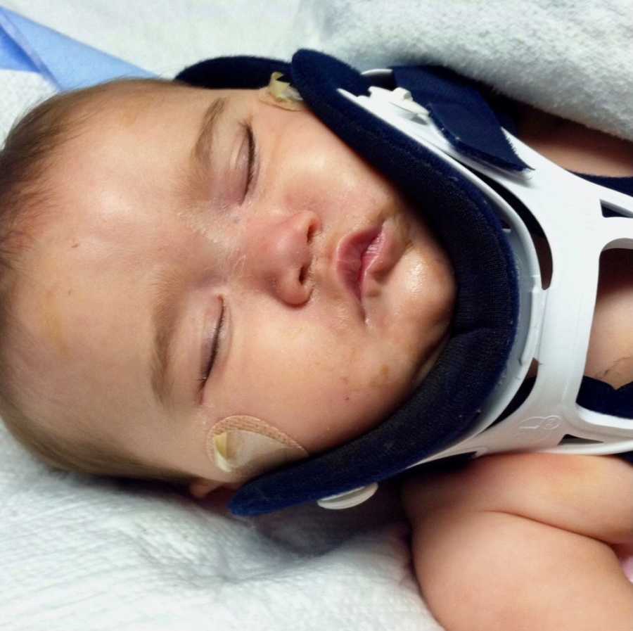 Baby in neck brace who suffers from shaken baby syndrome