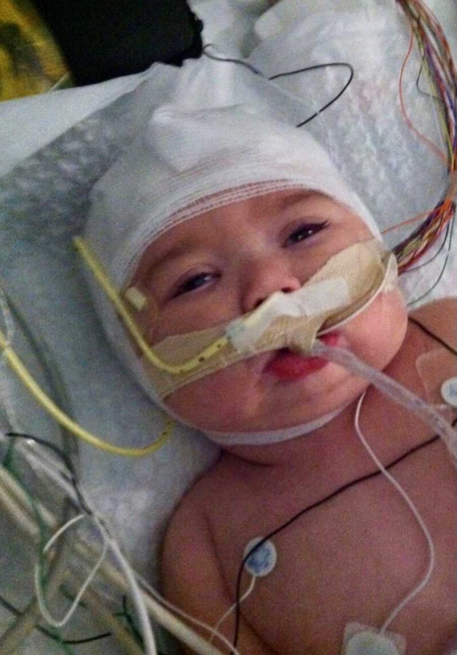 Close up of baby with shaken baby syndrome's face with bandages around her head and tube in her mouth