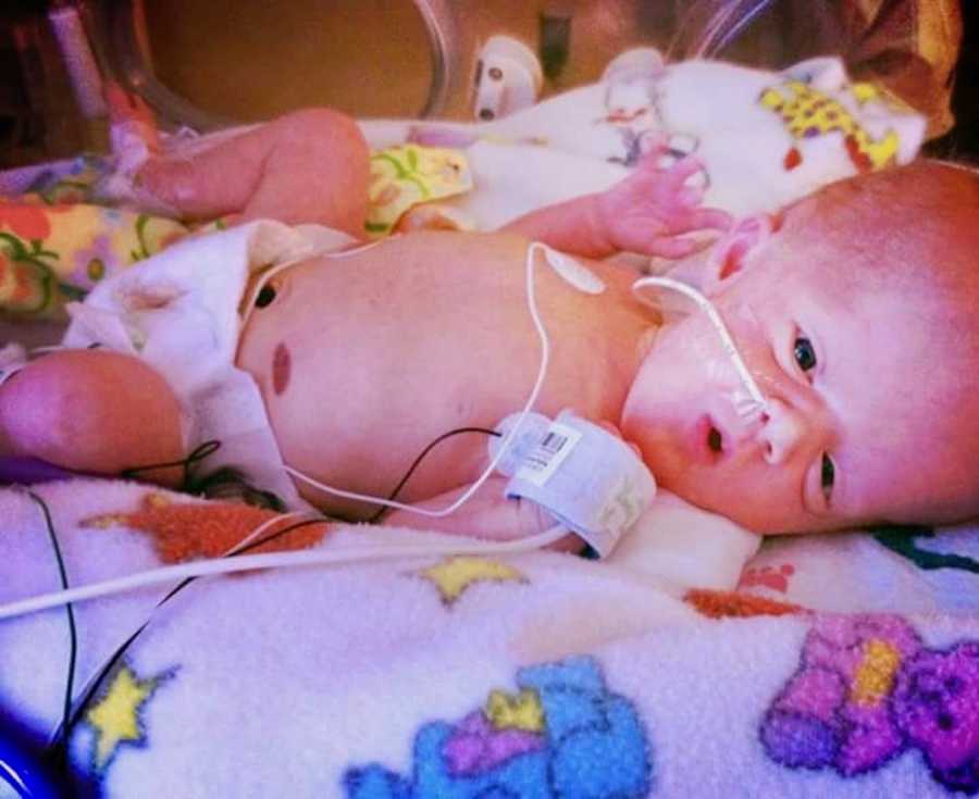 Newborn in NICU who had terminal brain cancer