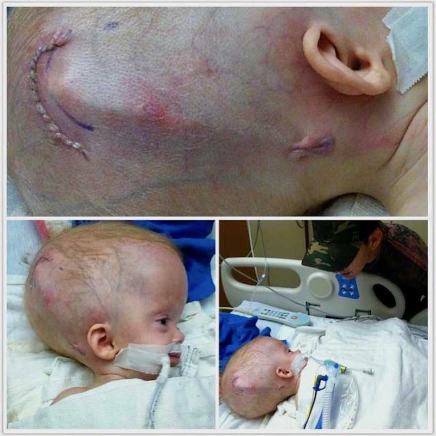 collage of newborn's head after having brain surgery