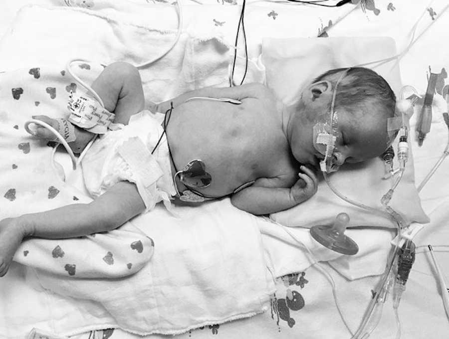 Newborn triplet in NICU with wires attached to him who won't survive 