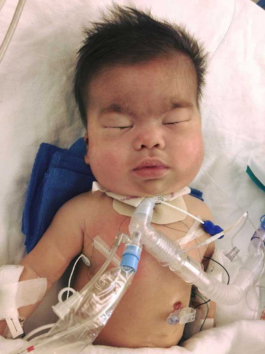 Baby in NICU with feeding tube in her neck