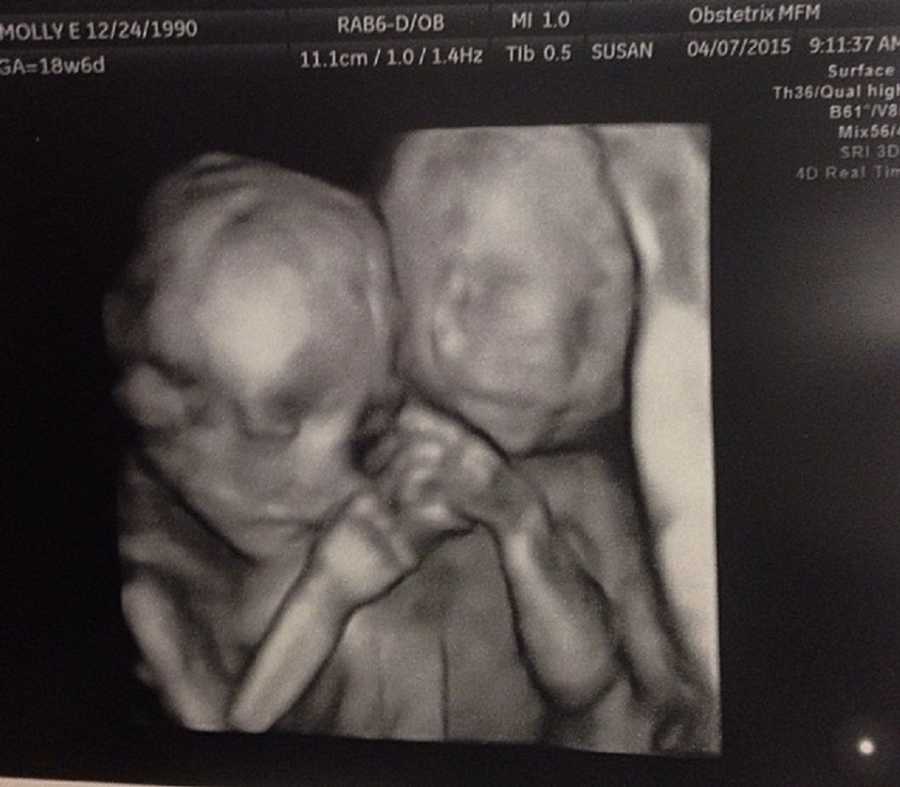 Ultrasound of twins