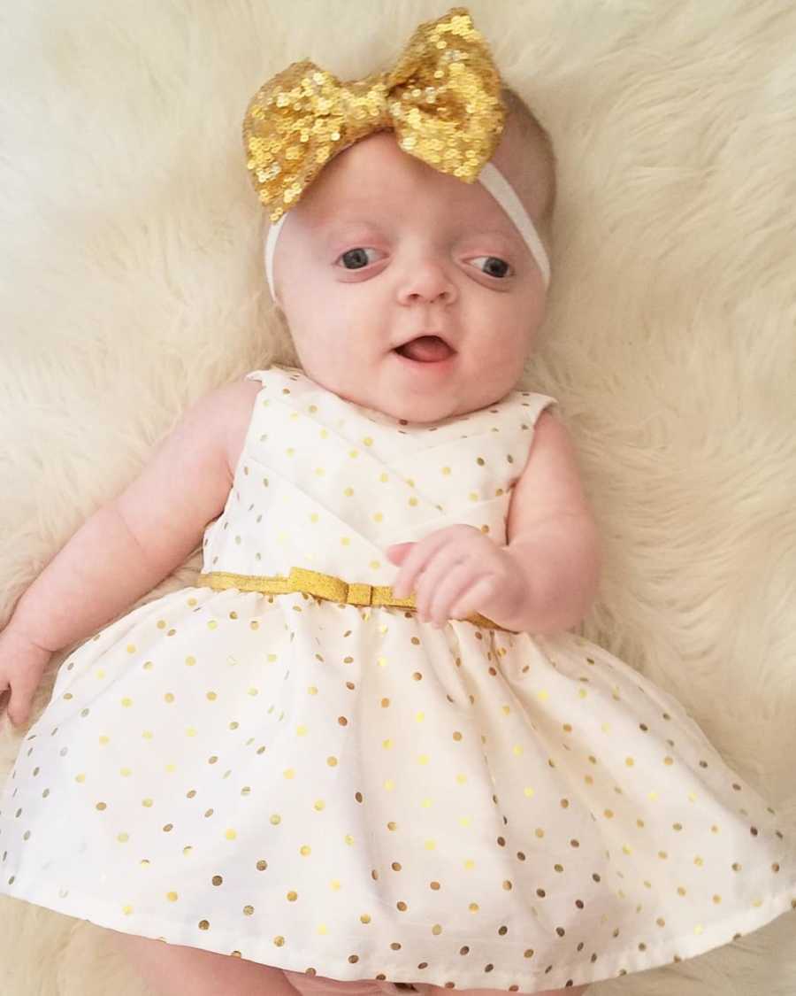 Baby with Pfeiffer Syndrome lays in white and gold polka dot dress and gold bow