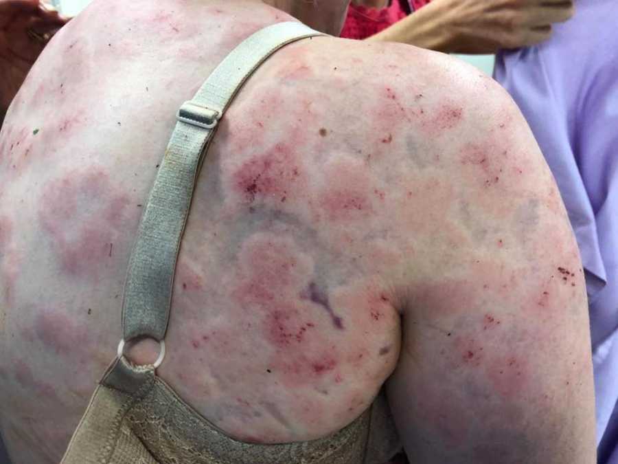 Mother's back red and bruised from shielding child from hail storm