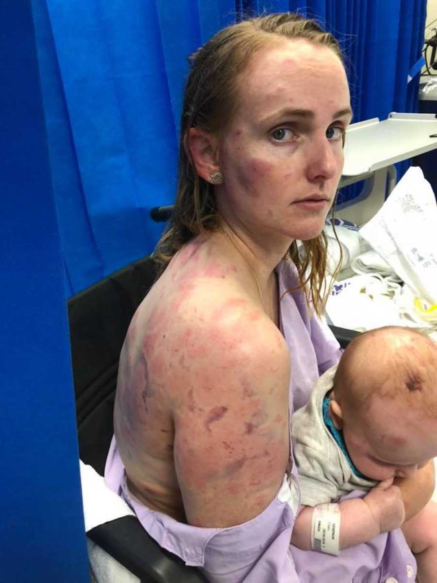 Mother who shielded infant from hail storm sits with bruised body