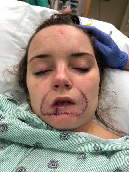 Woman in hospital bed with stitches around her mouth from abusive boyfriend