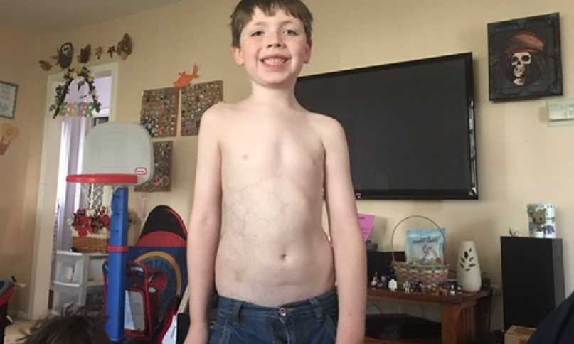 Young boy with CMTC smiles while standing shirtless in home