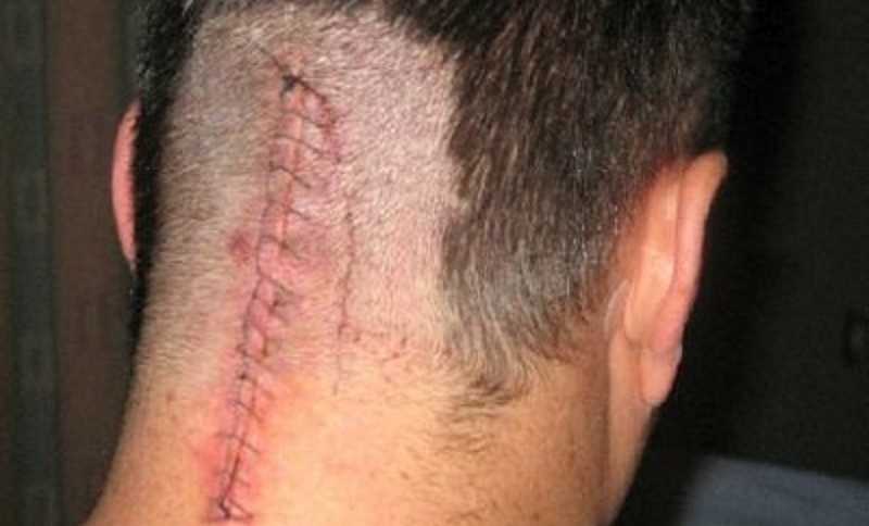 Stitches on back of man's head who had brain surgery to remove tumor