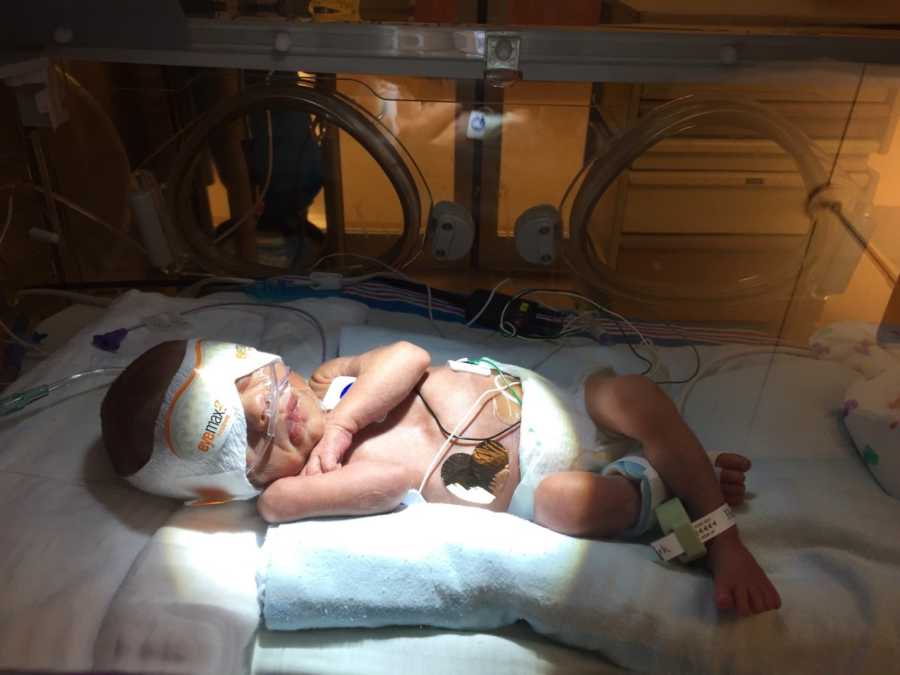 Newborn lays in NICU with bandage around eyes