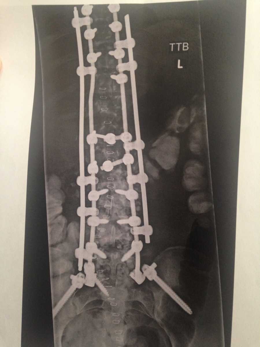 X-ray of woman's spine after car crash that left her paralyzed from waist down