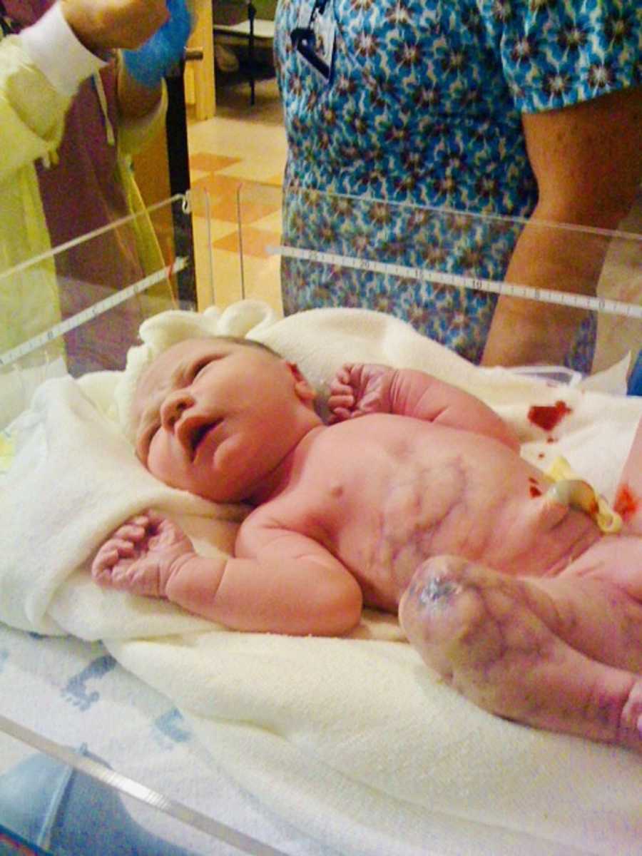 Newborn with CMTC lying in NICU