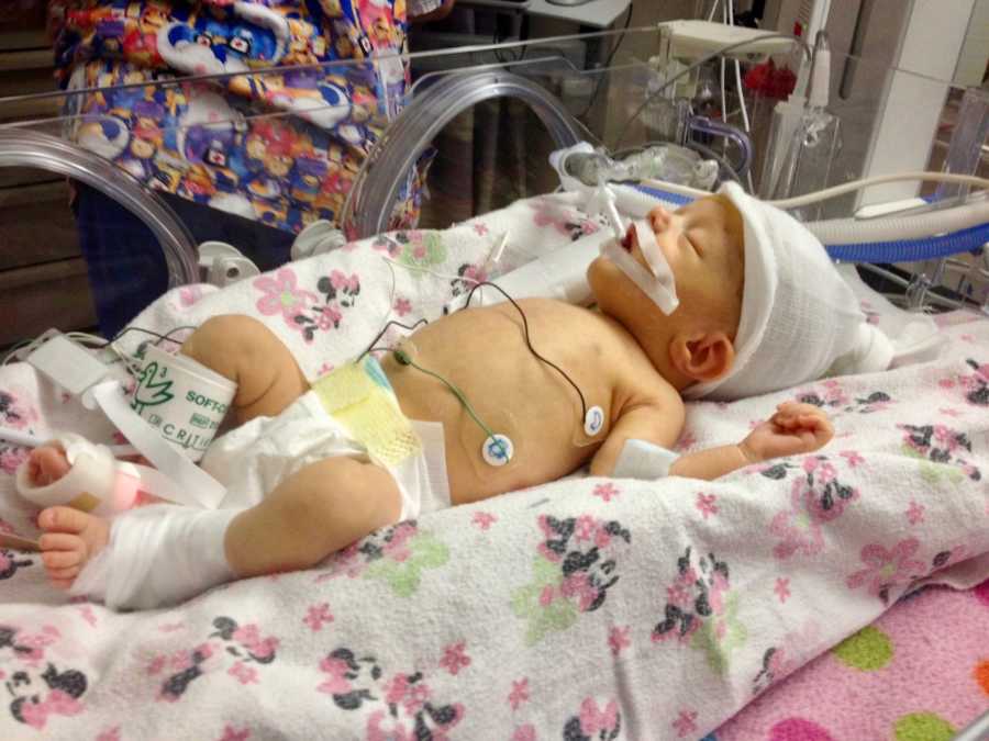 Newborn girl laying in NICU who needs brain surgery