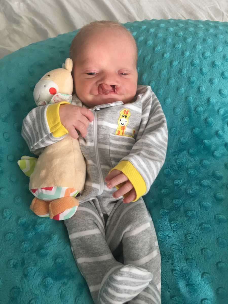 Baby with cleft palette lays on fuzzy blanket in onesie holding onto stuffed animal