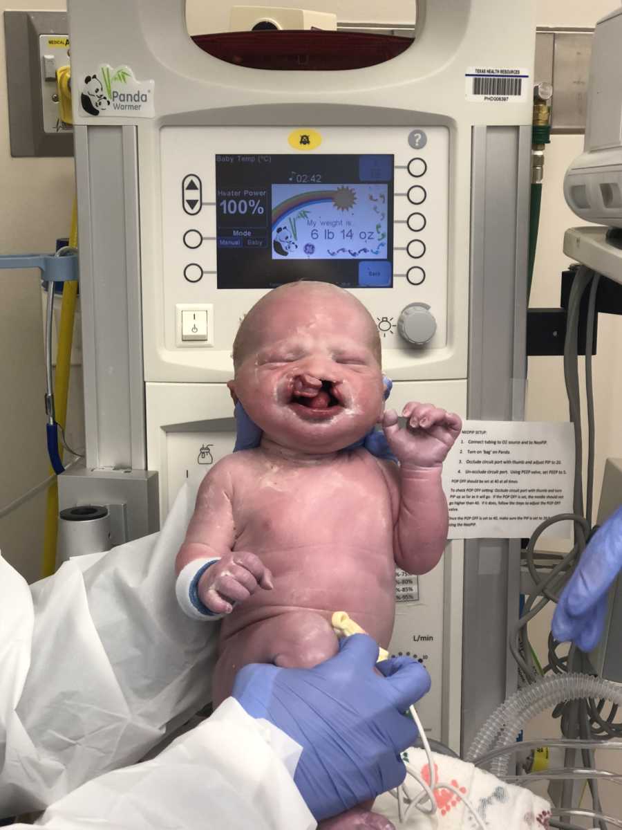 Newborn baby with cleft palette is held up by doctor in front of medical machine 