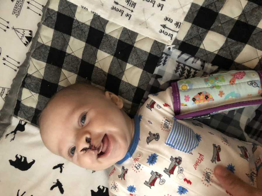 Baby who had cleft palette surgery lays smiling on quilt