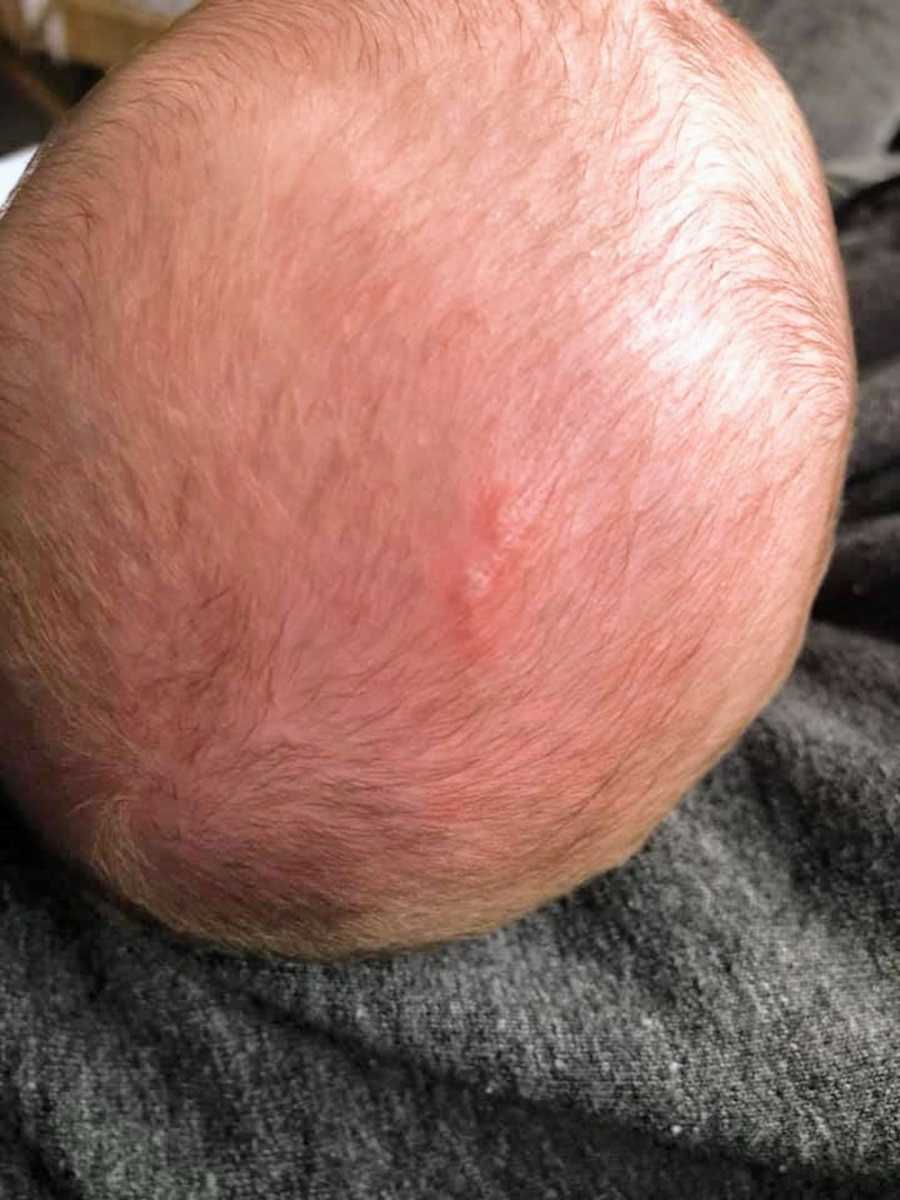 Red patch on baby's head that parent's thought was eczema but is herpes