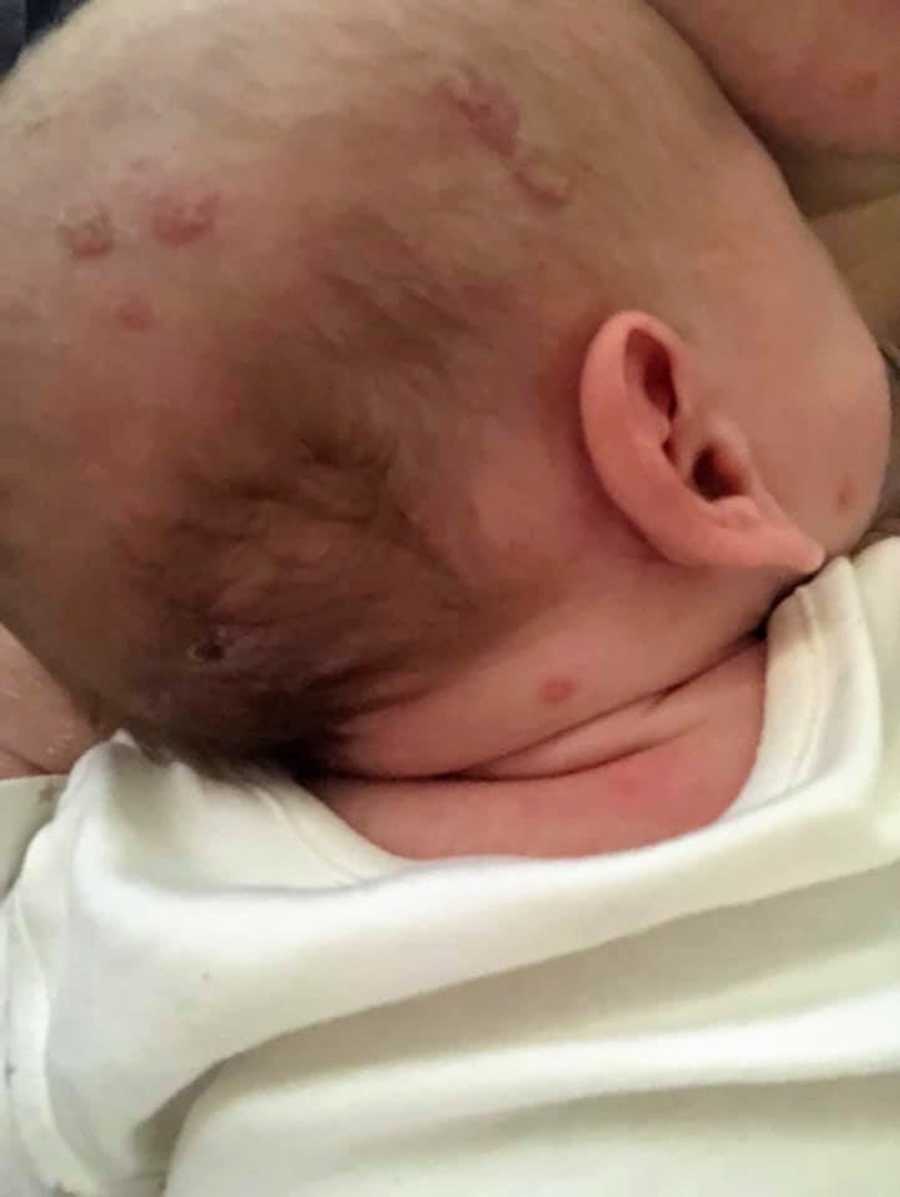 Patches on baby's head that look like eczema