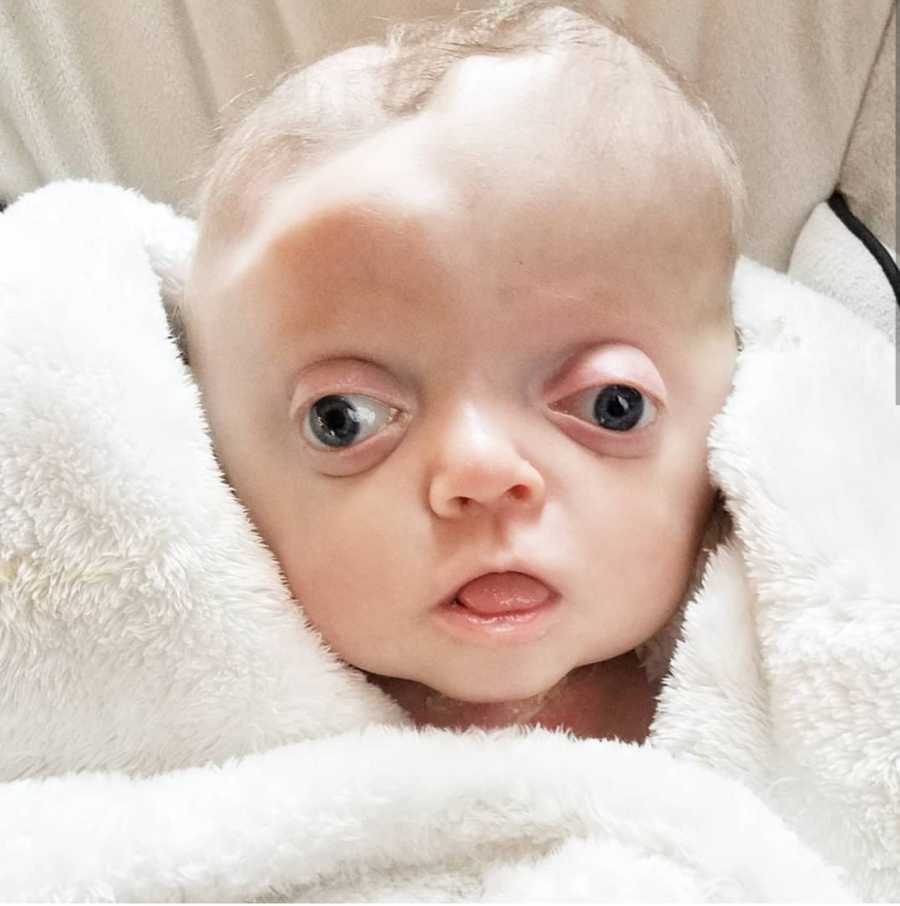 Close up of baby with Pfeiffer Syndrome's head that his wrapped in white fuzzy blanket