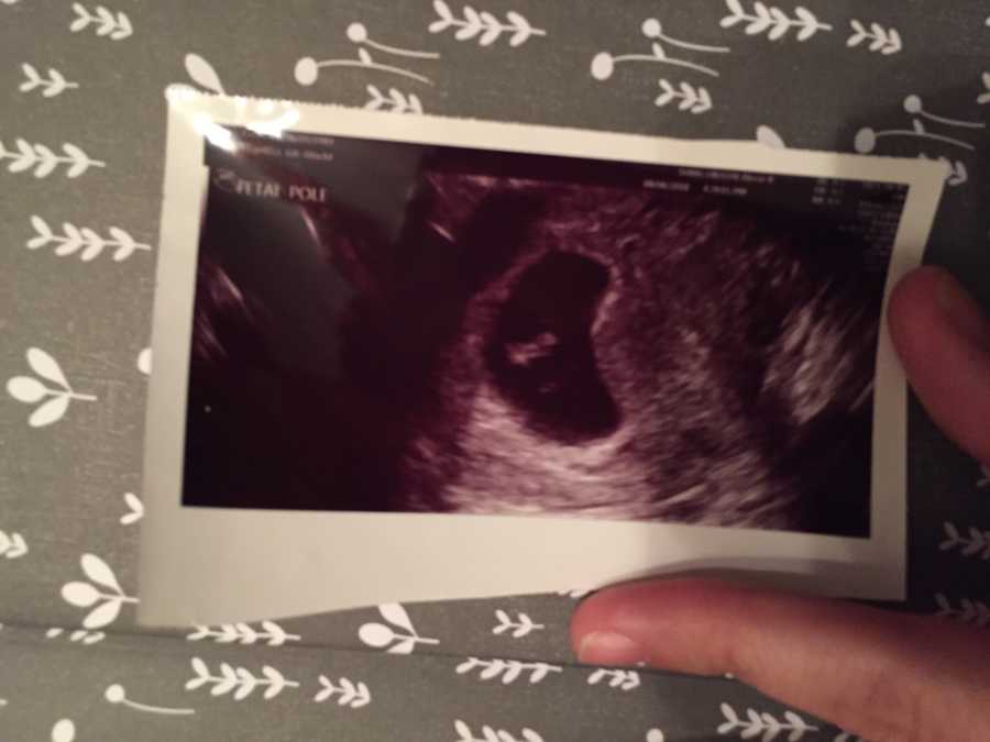 Close up of ultrasound picture 