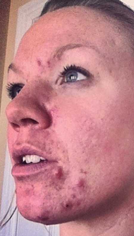 Close up of teens face who has cystic acne and is bullied at school