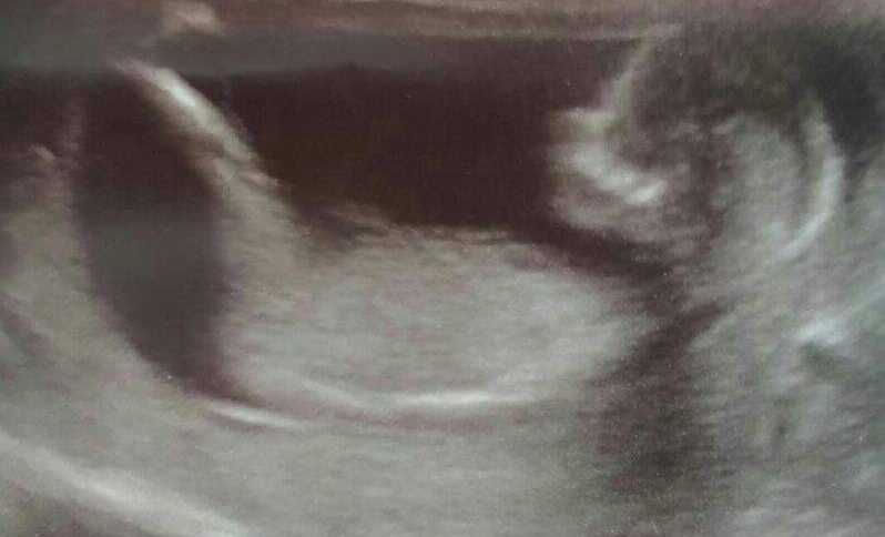 Ultrasound picture of baby woman had after several miscarriages
