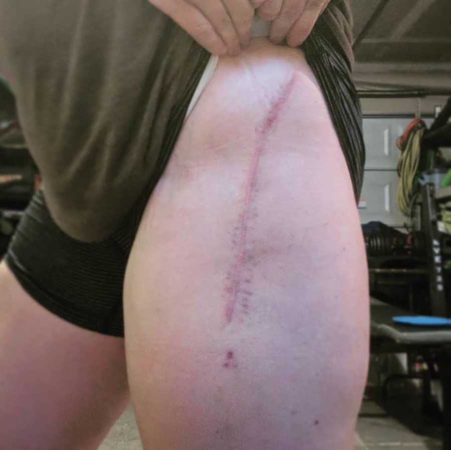 Large scar on woman thigh from where cancer was cut out