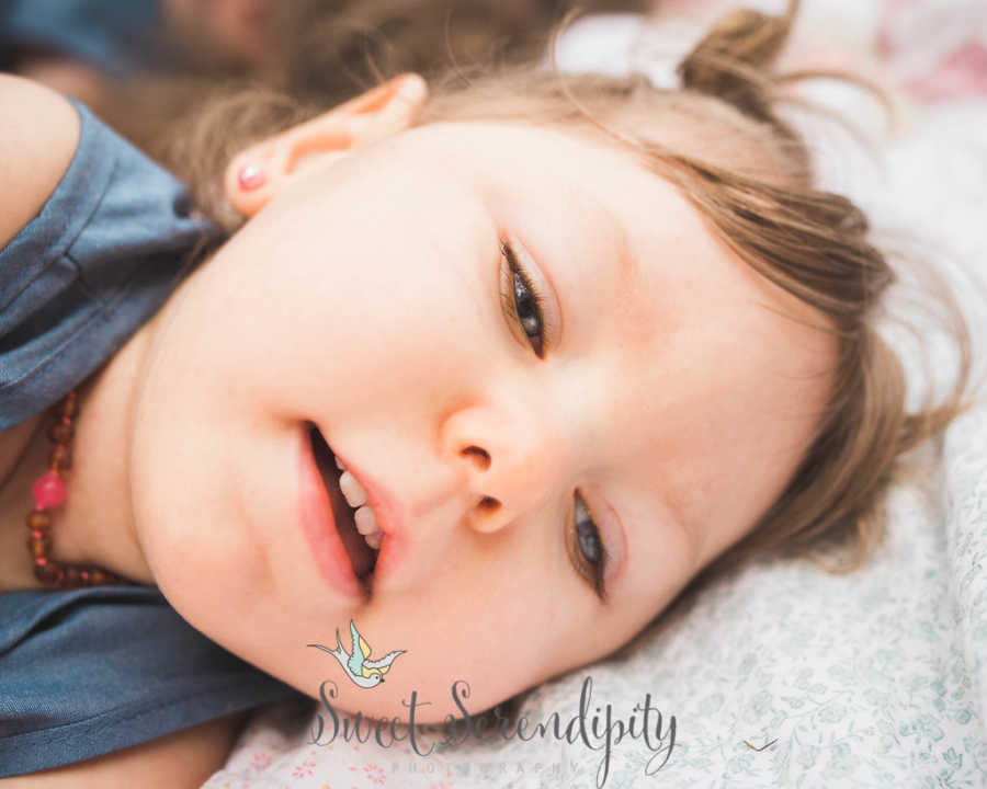 Close up of little girls face with bilateral open lip schizencephaly