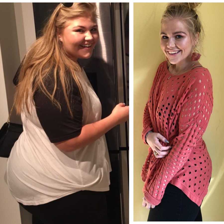 Woman who was bullied for her weight before and after gastric bypass surgery