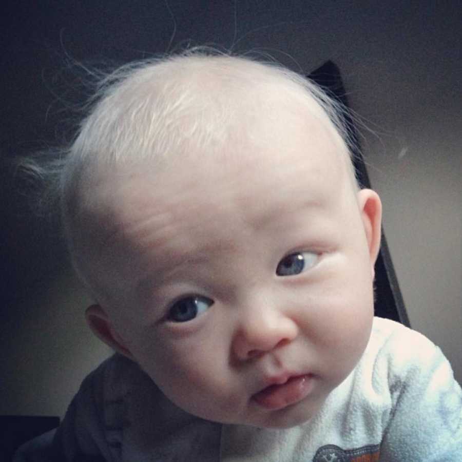 Close up of albino baby's head who has bright white hair