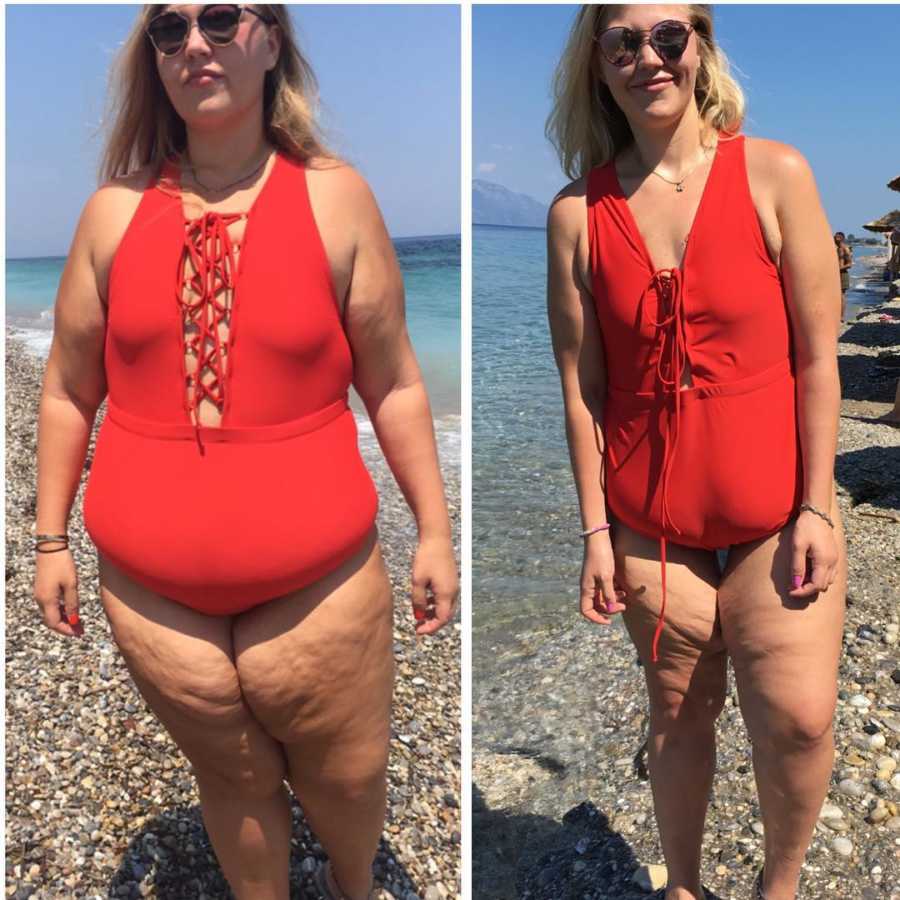 Woman stands in red bathing suit before and after gastric bypass surgery