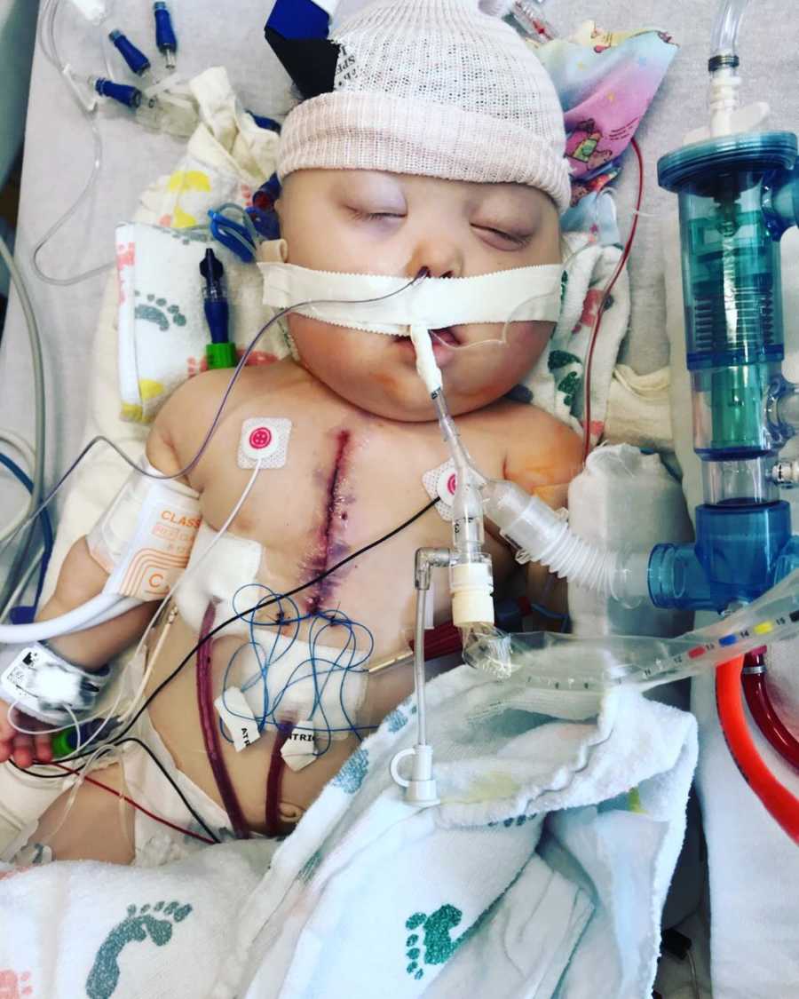 Baby twin in PICU after having open heart surgery