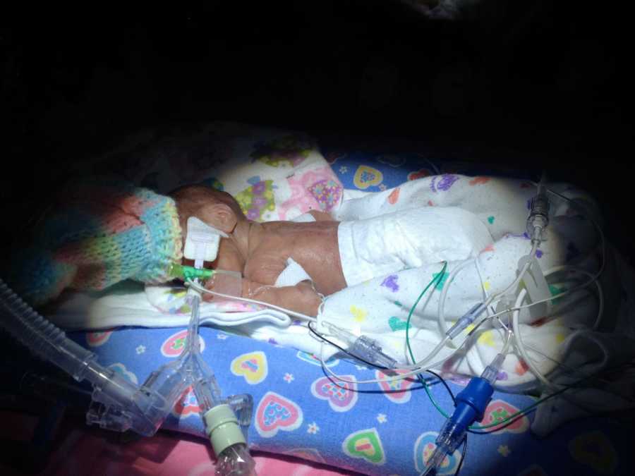 Preemie baby lays in NICU on her stomach
