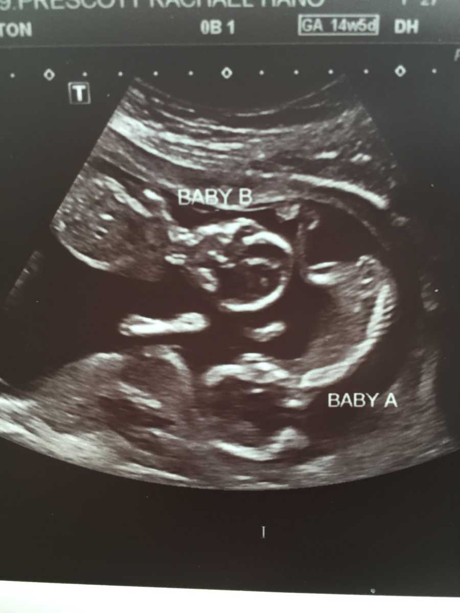 Ultrasound picture of twins 