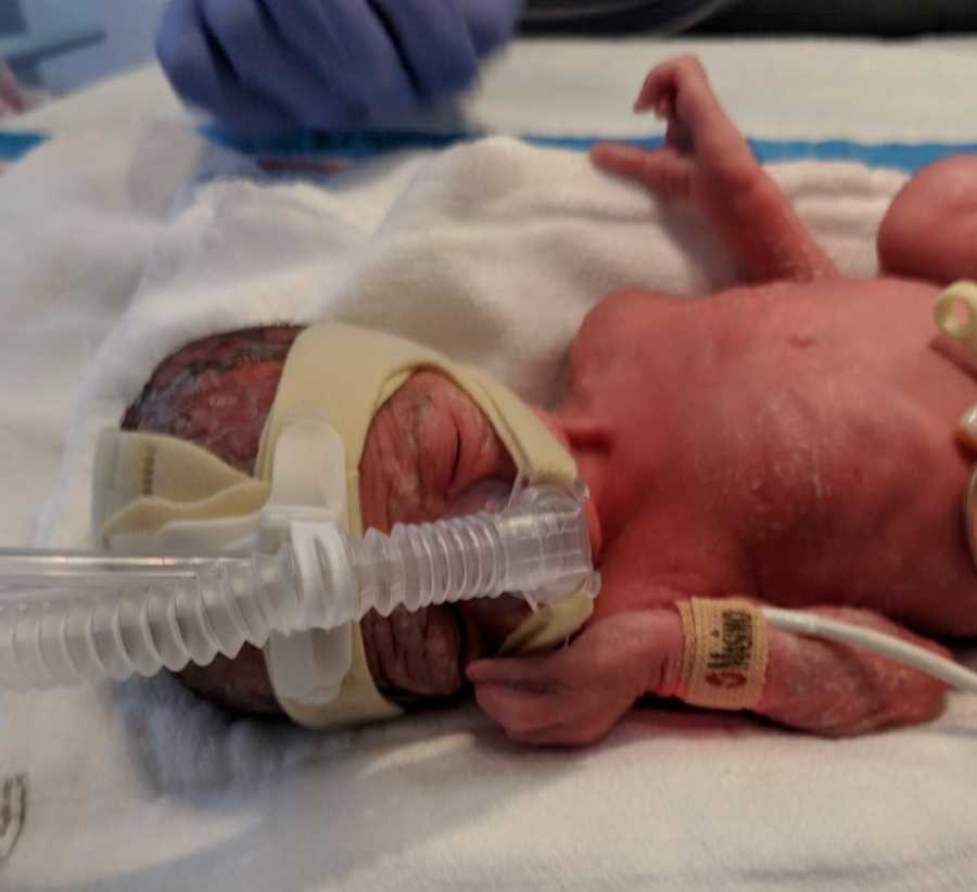 Newborn laying on her back on NICU with CPAP machine over her head