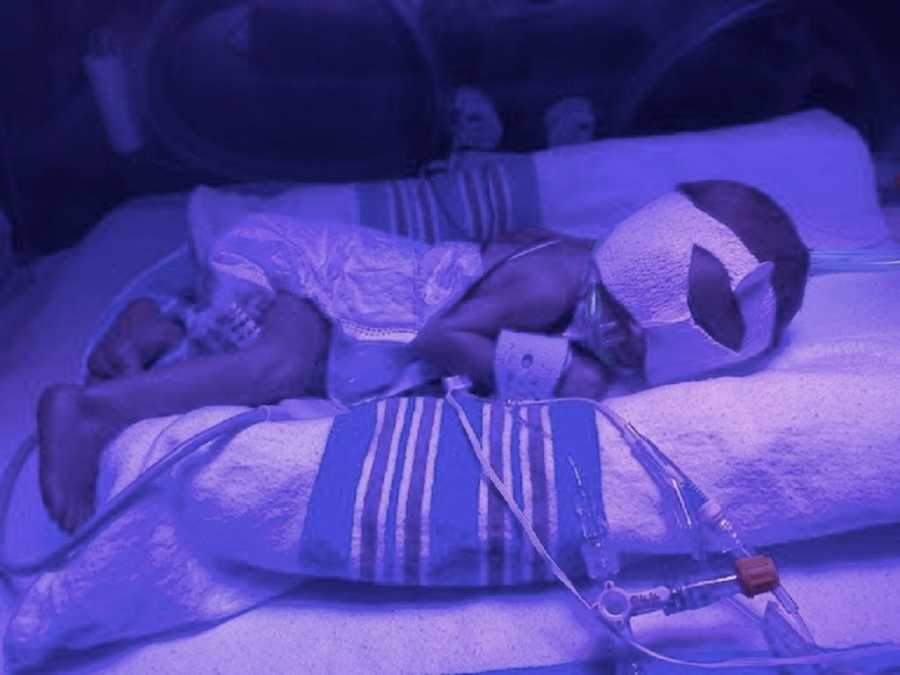 Preemie lays in NICU under blue light with bandage wrapped around her head