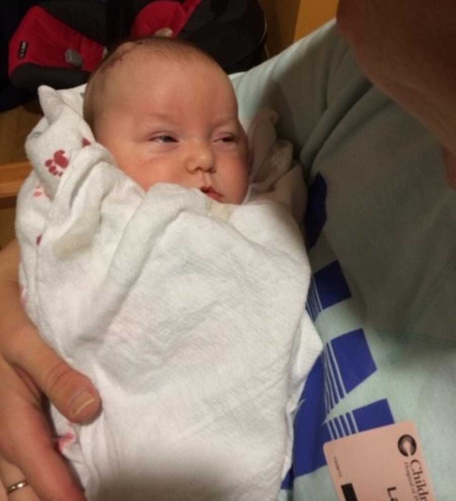 Newborn with bilateral open lip schizencephaly swaddled in white blanket held in arms of person