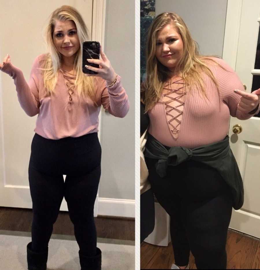 Before and after picture of woman who went through gastric bypass surgery