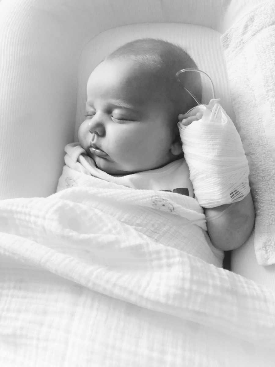 Little baby with Horner Syndrome lays on her back asleep