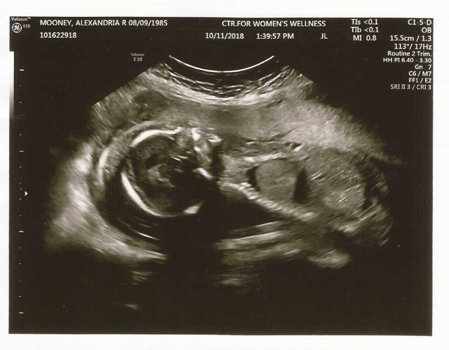 Ultrasound picture of birth photographer's baby