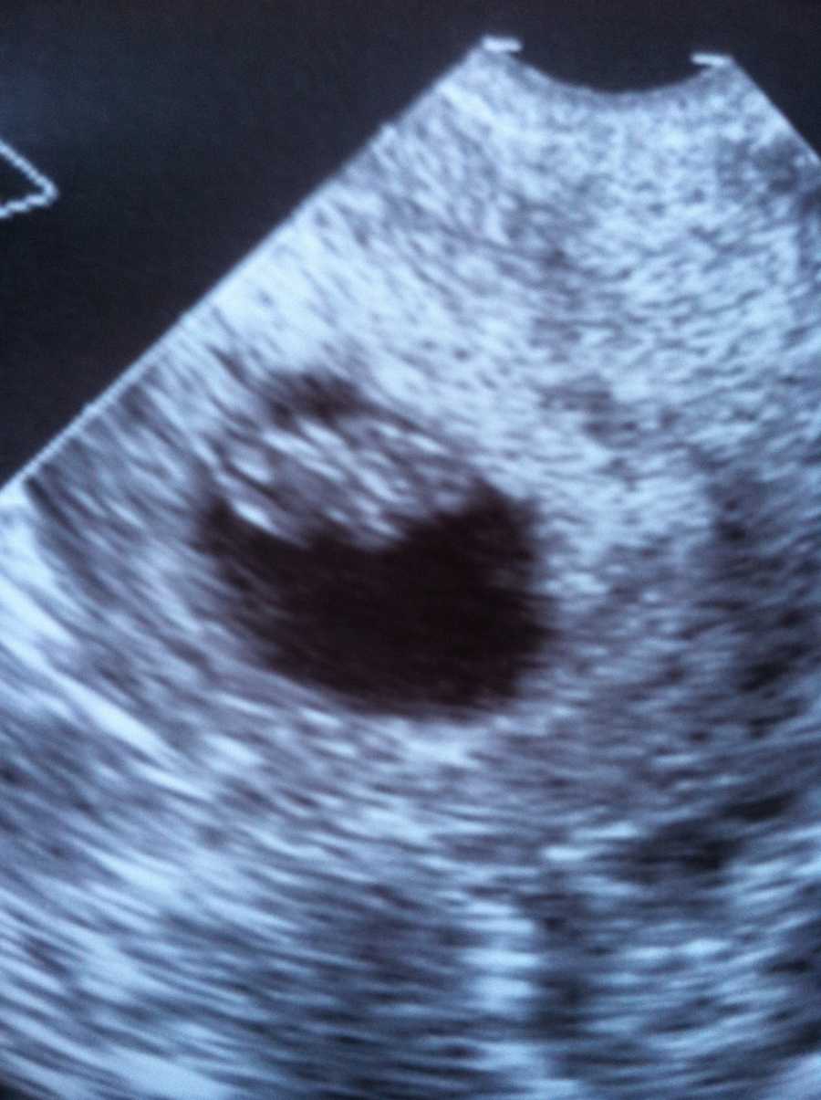 Ultrasound of baby