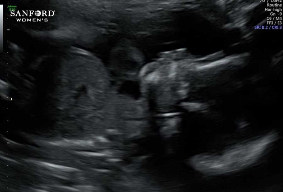 Ultrasound of woman's baby who thought there was something wrong