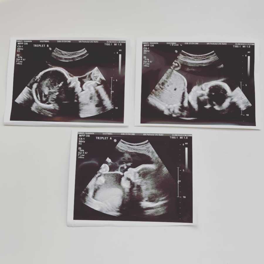 Ultrasound pictures of husband with Chiari Malformation and wife's triplets